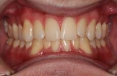 Invisalign: Moderate Crowding with Deep Bite