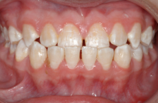 Fixed: Generalized Spacing and Class III Anterior Dental Relationship