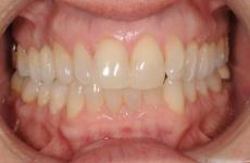 Invisalign: Class I with Moderate Crowding