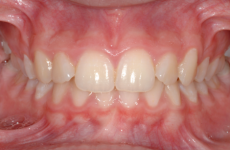 Fixed: anterior crowding and increased overbite